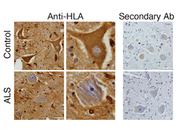Antibody staining against HLA protein in post mortem donor tissues shows a significant decrease in ALS end-stage patient spinal motor neurons.